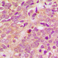 Antibody - Immunohistochemical analysis of PRKD1/2/3 (pS738/S742) staining in human breast cancer formalin fixed paraffin embedded tissue section. The section was pre-treated using heat mediated antigen retrieval with sodium citrate buffer (pH 6.0). The section was then incubated with the antibody at room temperature and detected using an HRP conjugated compact polymer system. DAB was used as the chromogen. The section was then counterstained with hematoxylin and mounted with DPX.