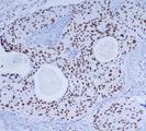 PRKDC / DNA-PKcs Antibody - Immunohistochemical analysis of paraffin-embedded Breast cancer using DNA-PKcs mouse monoclonal antibody (1:200 dilution).Antigen retrieval was performed by pressure cooking in citrate buffer (pH 6.0).