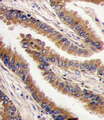 PRKX Antibody - Formalin-fixed and paraffin-embedded human lung carcinoma tissue reacted with PRKX antibody , which was peroxidase-conjugated to the secondary antibody, followed by DAB staining. This data demonstrates the use of this antibody for immunohistochemistry; clinical relevance has not been evaluated.