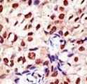 PRMT2 Antibody - Formalin-fixed and paraffin-embedded human cancer tissue reacted with the primary antibody, which was peroxidase-conjugated to the secondary antibody, followed by DAB staining. This data demonstrates the use of this antibody for immunohistochemistry; clinical relevance has not been evaluated. BC = breast carcinoma; HC = hepatocarcinoma.
