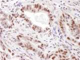 PRMT4 / CARM1 Antibody - Detection of Human CARM1/PRMT4 by Immunohistochemistry. Sample: FFPE section of human stomach carcinoma. Antibody: Affinity purified rabbit anti-CARM1/PRMT4 used at a dilution of 1:1000 (1 ug/ml).