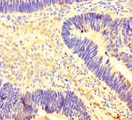PRMT4 / CARM1 Antibody - Immunohistochemistry of paraffin-embedded human ovarian cancer at dilution of 1:100