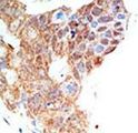 PRMT5 Antibody - Formalin-fixed and paraffin-embedded human cancer tissue reacted with the primary antibody, which was peroxidase-conjugated to the secondary antibody, followed by DAB staining. This data demonstrates the use of this antibody for immunohistochemistry; clinical relevance has not been evaluated. BC = breast carcinoma; HC = hepatocarcinoma.