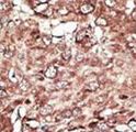 PRMT7 Antibody - Formalin-fixed and paraffin-embedded human cancer tissue reacted with the primary antibody, which was peroxidase-conjugated to the secondary antibody, followed by AEC staining. This data demonstrates the use of this antibody for immunohistochemistry; clinical relevance has not been evaluated. BC = breast carcinoma; HC = hepatocarcinoma.