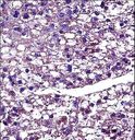 PROC / Protein C Antibody - PROC Antibody immunohistochemistry of formalin-fixed and paraffin-embedded human hepatocarcinoma followed by peroxidase-conjugated secondary antibody and DAB staining.