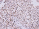 PROC / Protein C Antibody - IHC of paraffin-embedded Breast ca, using Protein C antibody at 1:250 dilution.