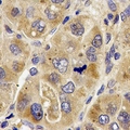 PRODH Antibody - Immunohistochemical analysis of PRODH staining in human liver cancer formalin fixed paraffin embedded tissue section. The section was pre-treated using heat mediated antigen retrieval with sodium citrate buffer (pH 6.0). The section was then incubated with the antibody at room temperature and detected using an HRP conjugated compact polymer system. DAB was used as the chromogen. The section was then counterstained with hematoxylin and mounted with DPX.