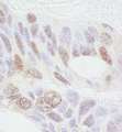 Prohibitin 2 / PHB2 Antibody - Detection of Human REA by Immunohistochemistry. Sample: FFPE section of human ovarian carcinoma. Antibody: Affinity purified rabbit anti-REA used at a dilution of 1:1000 (1 ug/ml). Detection: DAB.