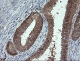 PROSC Antibody - IHC of paraffin-embedded Adenocarcinoma of Human endometrium tissue using anti-PROSC mouse monoclonal antibody.