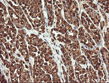 PROSC Antibody - IHC of paraffin-embedded Carcinoma of Human thyroid tissue using anti-PROSC mouse monoclonal antibody.