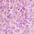 Protein Kinase A (PKA) Catalytic Subunit Antibody - Immunohistochemical analysis of PKA C alpha/beta/gamma (pT198) staining in human breast cancer formalin fixed paraffin embedded tissue section. The section was pre-treated using heat mediated antigen retrieval with sodium citrate buffer (pH 6.0). The section was then incubated with the antibody at room temperature and detected using an HRP conjugated compact polymer system. DAB was used as the chromogen. The section was then counterstained with hematoxylin and mounted with DPX.