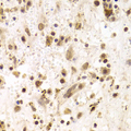 PRPF3 Antibody - Immunohistochemistry of paraffin-embedded liver cancer tissue.