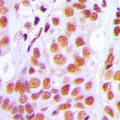 PRPF3 Antibody - Immunohistochemical analysis of PRPF3 staining in human breast cancer formalin fixed paraffin embedded tissue section. The section was pre-treated using heat mediated antigen retrieval with sodium citrate buffer (pH 6.0). The section was then incubated with the antibody at room temperature and detected using an HRP conjugated compact polymer system. DAB was used as the chromogen. The section was then counterstained with hematoxylin and mounted with DPX.
