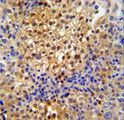 PRPF38A Antibody - PR38A Antibody immunohistochemistry of formalin-fixed and paraffin-embedded human cervix carcinoma followed by peroxidase-conjugated secondary antibody and DAB staining.