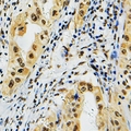 PRPF39 Antibody - Immunohistochemical analysis of PRPF39 staining in human lung cancer formalin fixed paraffin embedded tissue section. The section was pre-treated using heat mediated antigen retrieval with sodium citrate buffer (pH 6.0). The section was then incubated with the antibody at room temperature and detected with HRP and DAB as chromogen. The section was then counterstained with hematoxylin and mounted with DPX.