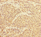 PRPF4 Antibody - Immunohistochemistry of paraffin-embedded human ovarian cancer at dilution of 1:100
