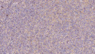 PRPH2 Antibody - 1:100 staining human lymph carcinoma tissue by IHC-P. The sample was formaldehyde fixed and a heat mediated antigen retrieval step in citrate buffer was performed. The sample was then blocked and incubated with the antibody for 1.5 hours at 22°C. An HRP conjugated goat anti-rabbit antibody was used as the secondary.