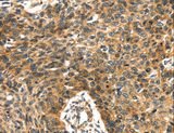 PRSS50 / TSP50 Antibody - Immunohistochemistry of paraffin-embedded Human esophagus cancer using PRSS50 Polyclonal Antibody at dilution of 1:30.