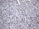 PRX-1 / PRRX1 Antibody - IHC of paraffin-embedded Adenocarcinoma of Human endometrium tissue using anti-PRRX1 mouse monoclonal antibody. (Heat-induced epitope retrieval by 10mM citric buffer, pH6.0, 120°C for 3min).
