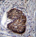 PSCA Antibody - PSCA Antibody immunohistochemistry of formalin-fixed and paraffin-embedded human prostate carcinoma followed by peroxidase-conjugated secondary antibody and DAB staining.
