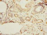 PSD4 Antibody - Immunohistochemistry of paraffin-embedded human breast cancer using antibody at dilution of 1:100.