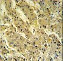 PSG7 Antibody - PSG7 Antibody IHC of formalin-fixed and paraffin-embedded hepatocarcinoma followed by peroxidase-conjugated secondary antibody and DAB staining.