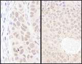 PSIP1 / LEDGF Antibody - Detection of Human and Mouse by Immunohistochemistry. Sample: FFPE sections of human lung carcinoma (left) and mouse renal cell carcinoma (right). Antibody: Affinity purified rabbit anti- used at a dilution of 1:1000 (1 Detection: DAB.