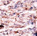 PSKH1 Antibody - Formalin-fixed and paraffin-embedded human cancer tissue reacted with the primary antibody, which was peroxidase-conjugated to the secondary antibody, followed by AEC staining. This data demonstrates the use of this antibody for immunohistochemistry; clinical relevance has not been evaluated. BC = breast carcinoma; HC = hepatocarcinoma.
