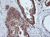 PSMA4 Antibody - IHC of paraffin-embedded Carcinoma of Human prostate tissue using anti-PSMA4 mouse monoclonal antibody.