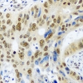 PSMA4 Antibody - Immunohistochemical analysis of PSMA4 staining in human colon cancer formalin fixed paraffin embedded tissue section. The section was pre-treated using heat mediated antigen retrieval with sodium citrate buffer (pH 6.0). The section was then incubated with the antibody at room temperature and detected using an HRP conjugated compact polymer system. DAB was used as the chromogen. The section was then counterstained with hematoxylin and mounted with DPX.