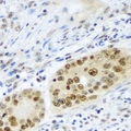 PSMB2 Antibody - Immunohistochemical analysis of PSMB2 staining in human colon cancer formalin fixed paraffin embedded tissue section. The section was pre-treated using heat mediated antigen retrieval with sodium citrate buffer (pH 6.0). The section was then incubated with the antibody at room temperature and detected using an HRP conjugated compact polymer system. DAB was used as the chromogen. The section was then counterstained with hematoxylin and mounted with DPX.