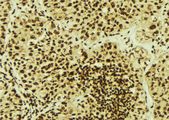 PSMB5 Antibody - 1:100 staining human breast carcinoma tissue by IHC-P. The sample was formaldehyde fixed and a heat mediated antigen retrieval step in citrate buffer was performed. The sample was then blocked and incubated with the antibody for 1.5 hours at 22°C. An HRP conjugated goat anti-rabbit antibody was used as the secondary.