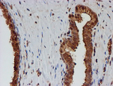 PSMB9 Antibody - IHC of paraffin-embedded Carcinoma of Human prostate tissue using anti-PSMB9 mouse monoclonal antibody.