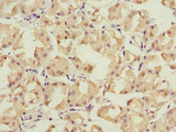 PSMD12 / Rpn5 Antibody - Immunohistochemistry of paraffin-embedded human gastric cancer at dilution 1:100