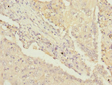 PSMD13 Antibody - Immunohistochemistry of paraffin-embedded human lung cancer at dilution 1:100