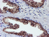PSMD2 Antibody - IHC of paraffin-embedded Carcinoma of Human prostate tissue using anti-PSMD2 mouse monoclonal antibody.