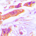PSMD6 Antibody - Immunohistochemical analysis of PSMD6 staining in human lung cancer formalin fixed paraffin embedded tissue section. The section was pre-treated using heat mediated antigen retrieval with sodium citrate buffer (pH 6.0). The section was then incubated with the antibody at room temperature and detected using an HRP conjugated compact polymer system. DAB was used as the chromogen. The section was then counterstained with hematoxylin and mounted with DPX.