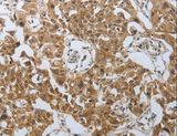 PSMD6 Antibody - Immunohistochemistry of paraffin-embedded Human lung cancer using PSMD6 Polyclonal Antibody at dilution of 1:40.