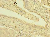 PSMD7 / MOV34 Antibody - Immunohistochemistry of paraffin-embedded human lung cancer using antibody at dilution of 1:100.