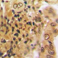 PSMD7 / MOV34 Antibody - Immunohistochemical analysis of PSMD7 staining in human lung cancer formalin fixed paraffin embedded tissue section. The section was pre-treated using heat mediated antigen retrieval with sodium citrate buffer (pH 6.0). The section was then incubated with the antibody at room temperature and detected using an HRP conjugated compact polymer system. DAB was used as the chromogen. The section was then counterstained with hematoxylin and mounted with DPX.