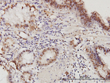 PSME2 Antibody - Immunoperoxidase of monoclonal antibody to PSME2 on formalin-fixed paraffin-embedded human stomach carcinoma. [antibody concentration 6 ug/ml].