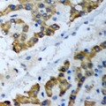 PSMF1 Antibody - Immunohistochemical analysis of PSMF1 staining in human liver cancer formalin fixed paraffin embedded tissue section. The section was pre-treated using heat mediated antigen retrieval with sodium citrate buffer (pH 6.0). The section was then incubated with the antibody at room temperature and detected using an HRP conjugated compact polymer system. DAB was used as the chromogen. The section was then counterstained with hematoxylin and mounted with DPX.