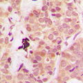 PTEN Antibody - Immunohistochemical analysis of PTEN staining in human breast cancer formalin fixed paraffin embedded tissue section. The section was pre-treated using heat mediated antigen retrieval with sodium citrate buffer (pH 6.0). The section was then incubated with the antibody at room temperature and detected using an HRP conjugated compact polymer system. DAB was used as the chromogen. The section was then counterstained with hematoxylin and mounted with DPX.