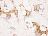PTGS2 / COX2 / COX-2 Antibody - Detection of Human COX-2 by Immunohistochemistry. Sample: FFPE section of human ovarian carcinoma. Antibody: Affinity purified rabbit anti-COX-2 used at a dilution of 1:1000 (1 ug/ml). Detection: DAB.