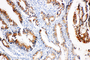 PTGS2 / COX2 / COX-2 Antibody - PTGS2 / COX2 / COX-2 antibody. IHC(P): Human Intestinal Cancer Tissue.