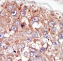 PTK6 / BRK Antibody - Formalin-fixed and paraffin-embedded human cancer tissue reacted with the primary antibody, which was peroxidase-conjugated to the secondary antibody, followed by AEC staining. This data demonstrates the use of this antibody for immunohistochemistry; clinical relevance has not been evaluated. BC = breast carcinoma; HC = hepatocarcinoma.