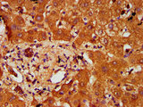 PTOV1 Antibody - Immunohistochemistry Dilution at 1:200 and staining in paraffin-embedded human liver tissue performed on a Leica BondTM system. After dewaxing and hydration, antigen retrieval was mediated by high pressure in a citrate buffer (pH 6.0). Section was blocked with 10% normal Goat serum 30min at RT. Then primary antibody (1% BSA) was incubated at 4°C overnight. The primary is detected by a biotinylated Secondary antibody and visualized using an HRP conjugated SP system.