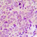 PTP1B Antibody - Immunohistochemical analysis of PTP1B staining in human breast cancer formalin fixed paraffin embedded tissue section. The section was pre-treated using heat mediated antigen retrieval with sodium citrate buffer (pH 6.0). The section was then incubated with the antibody at room temperature and detected using an HRP-conjugated compact polymer system. DAB was used as the chromogen. The section was then counterstained with hematoxylin and mounted with DPX.