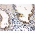 PTP4A2 / PRL-2 Antibody - PTP4A2 antibody IHC-paraffin. IHC(P): Human Prostatic Cancer Tissue.