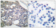PTPN6 / SHP1 Antibody - Immunohistochemistry analysis of paraffin-embedded human breast carcinoma, using SHP-1 (Phospho-Tyr536) Antibody. The picture on the right is blocked with the phospho peptide.